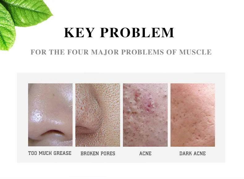 **Aichun Beauty Anti-Acne & Pimple Repair Cream 30ml**
