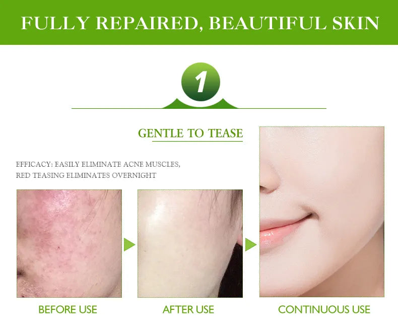 **Aichun Beauty Anti-Acne & Pimple Repair Cream 30ml**