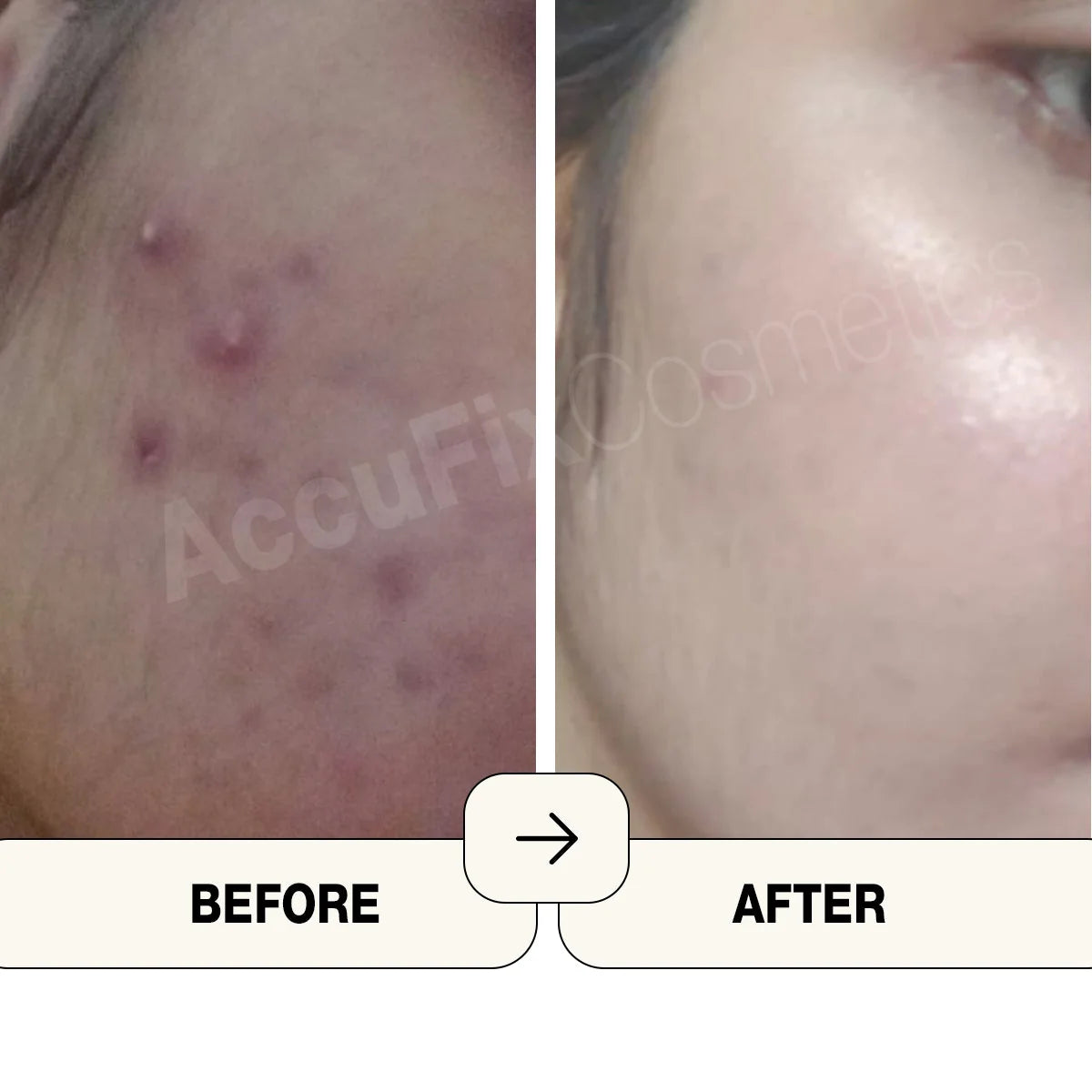 **AccuFix Salicylic Acid Cleanser**