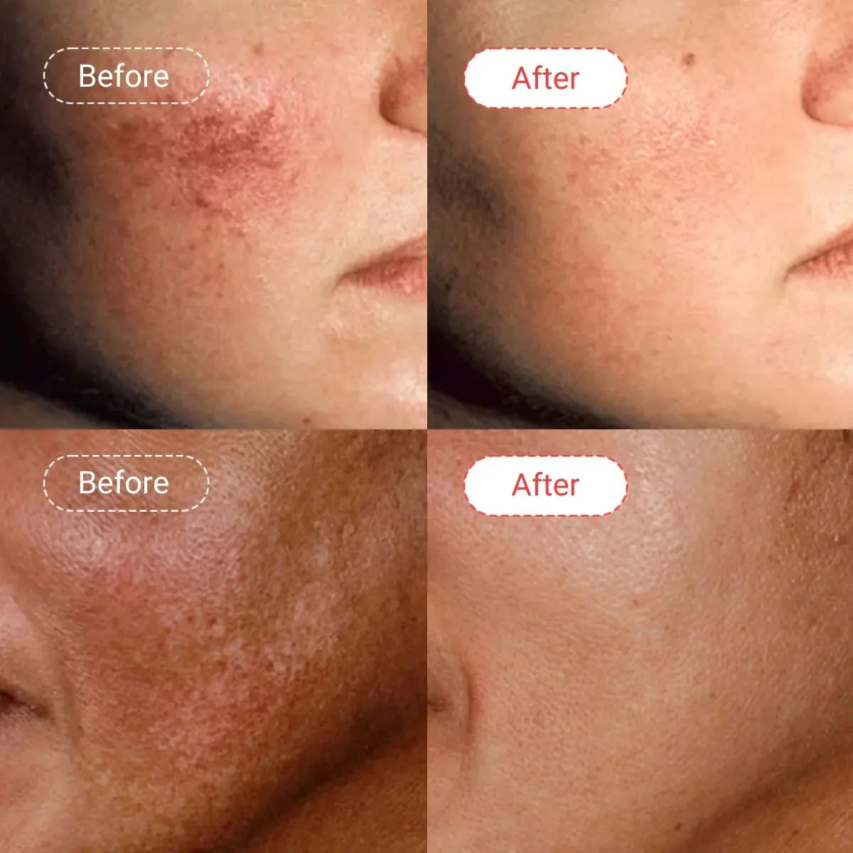 AccuFix - Azelaic Acid Serum