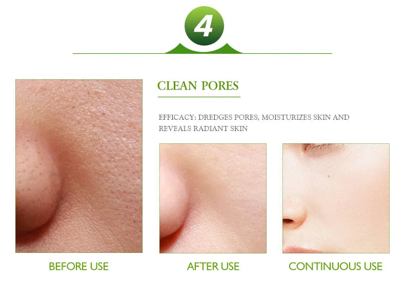 **Aichun Beauty Anti-Acne & Pimple Repair Cream 30ml**
