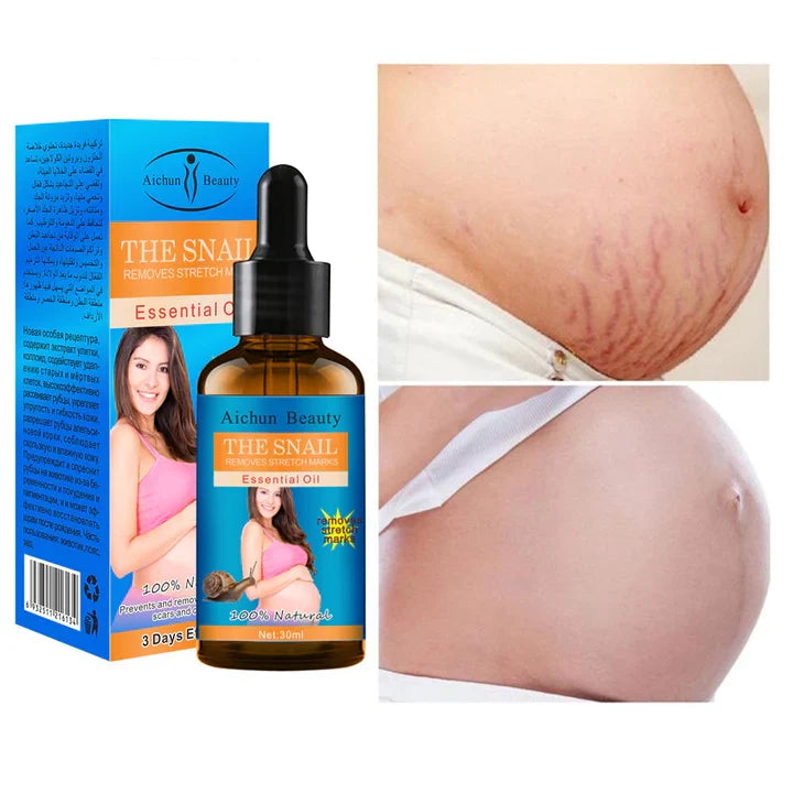 **Aichun Beauty Snail Stretch Mark Essential Oil**